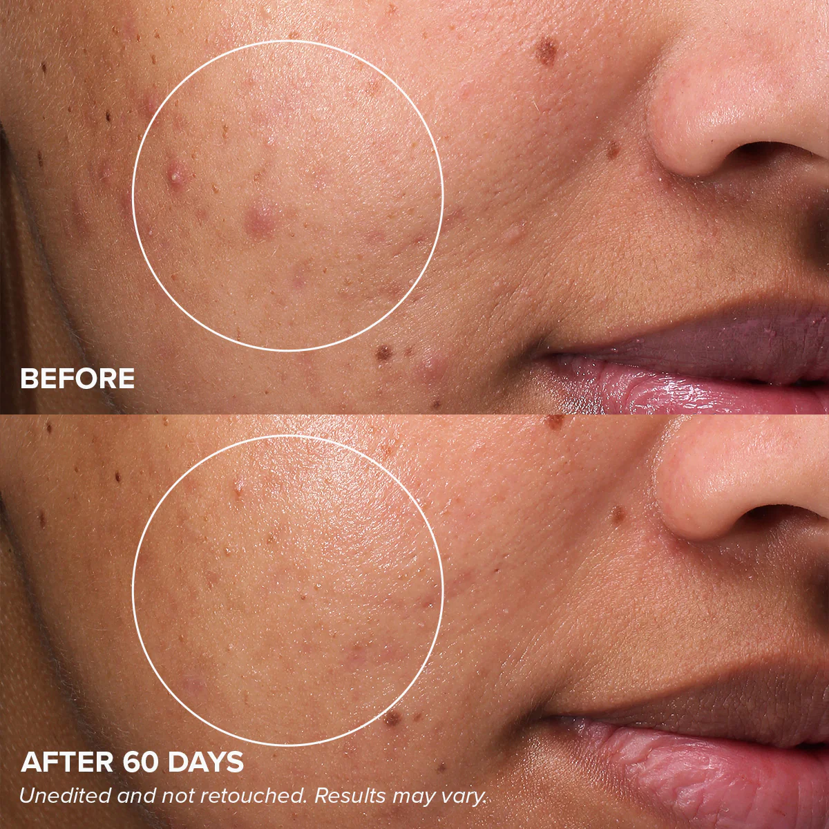 Gentle Acne Kit - Image 11