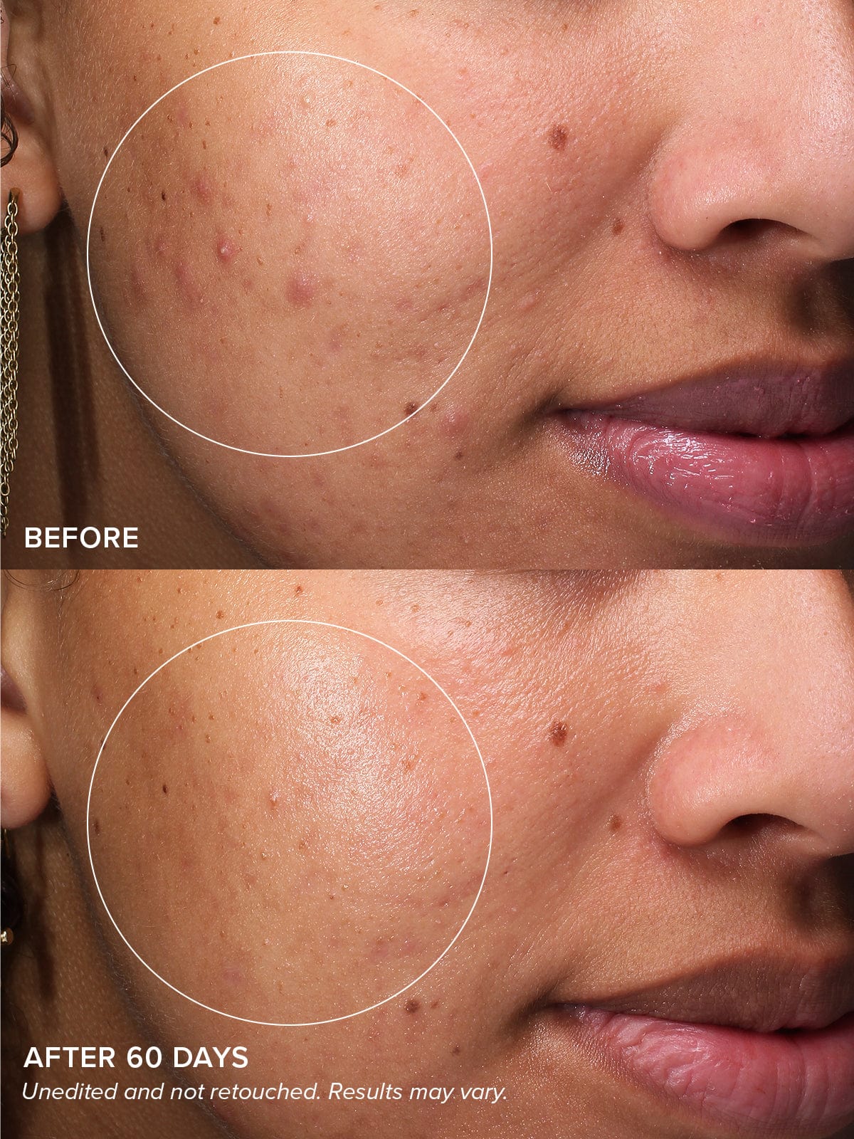 Gentle Acne Kit - Image 4