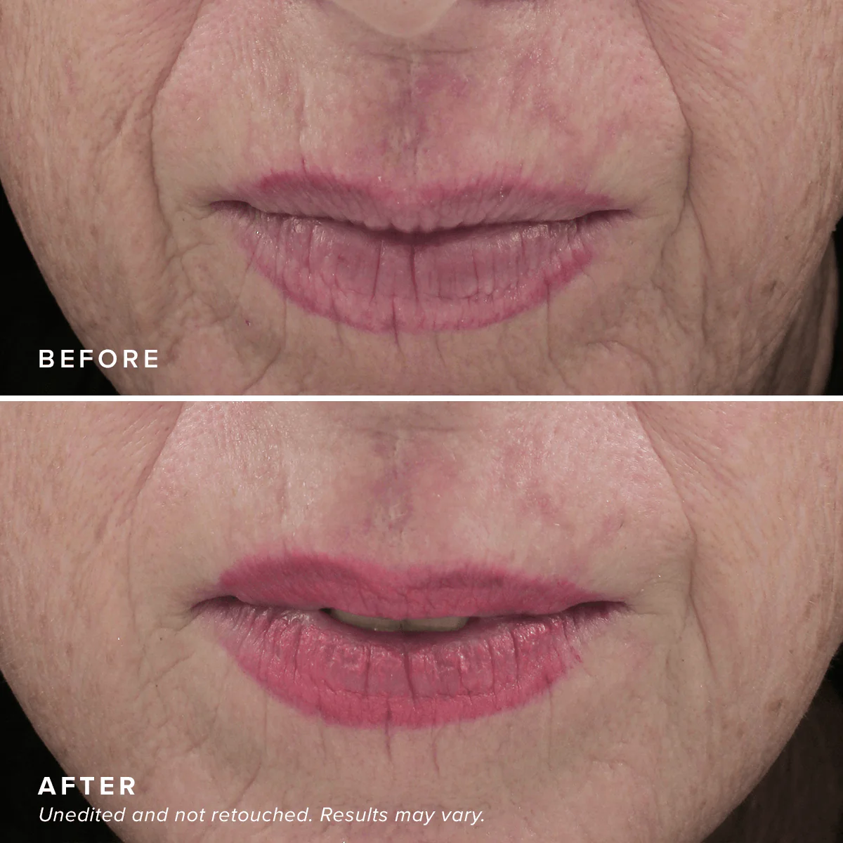 Needle-less® Serum - Image 7